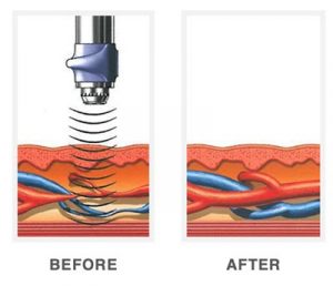pulse wave therapy results before and after the treatment