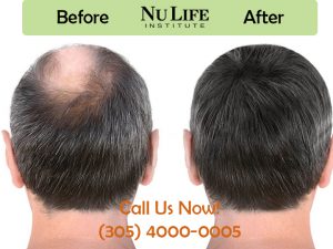 Hair Loss Treatment with PRP Miami FL