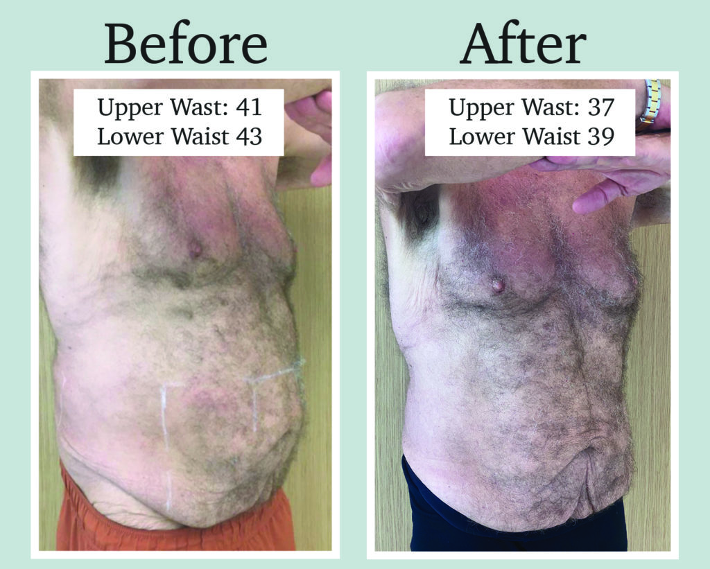 Coolsculpting Miami Before And After Images